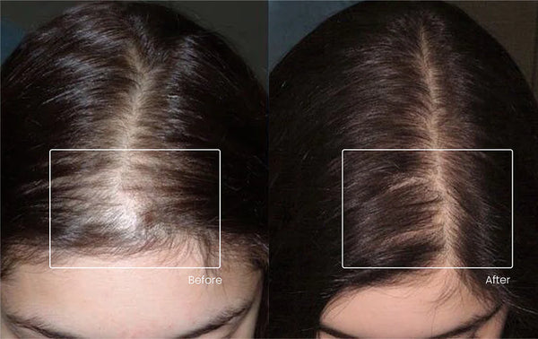 NeuroGlow Scalp Massager